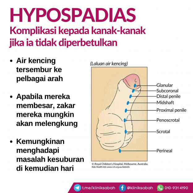 Hypospadias